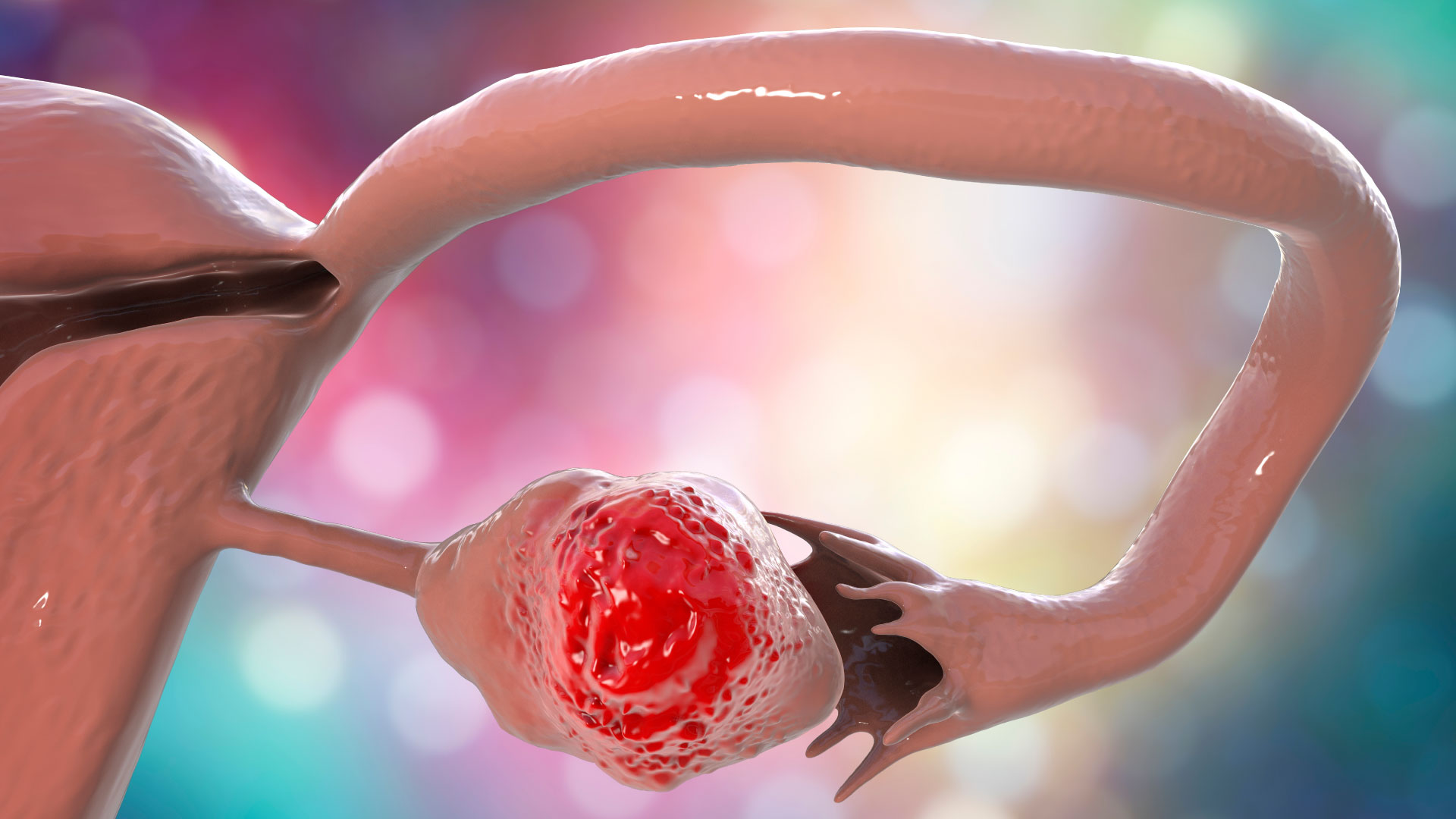 Cáncer sincrónico de ovario y cúpula vaginal. Reporte de un caso y revisión de la bibliografía