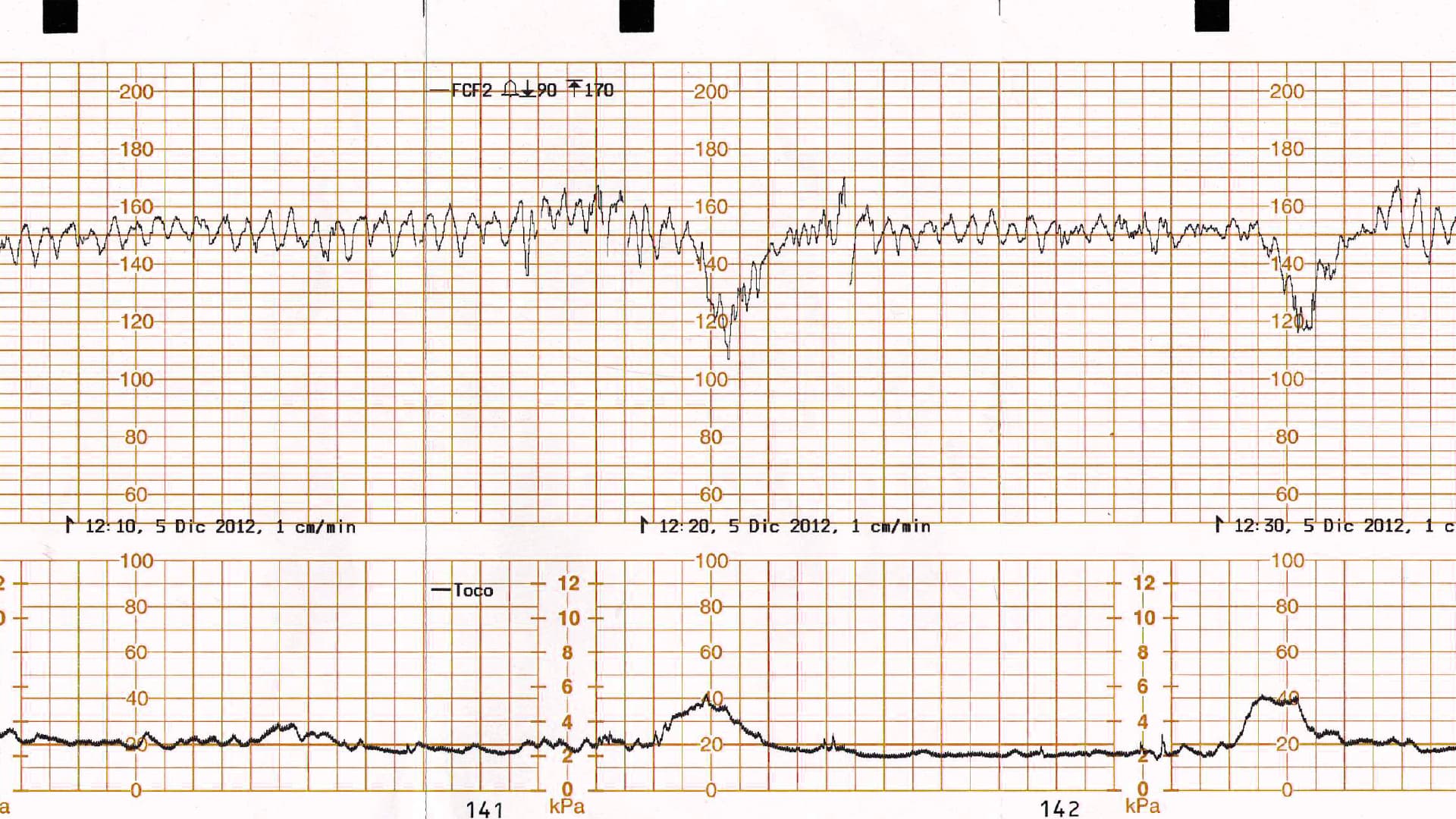 Suplementación con oxígeno en el escenario de un registro cardiotocográfico categoría II o III