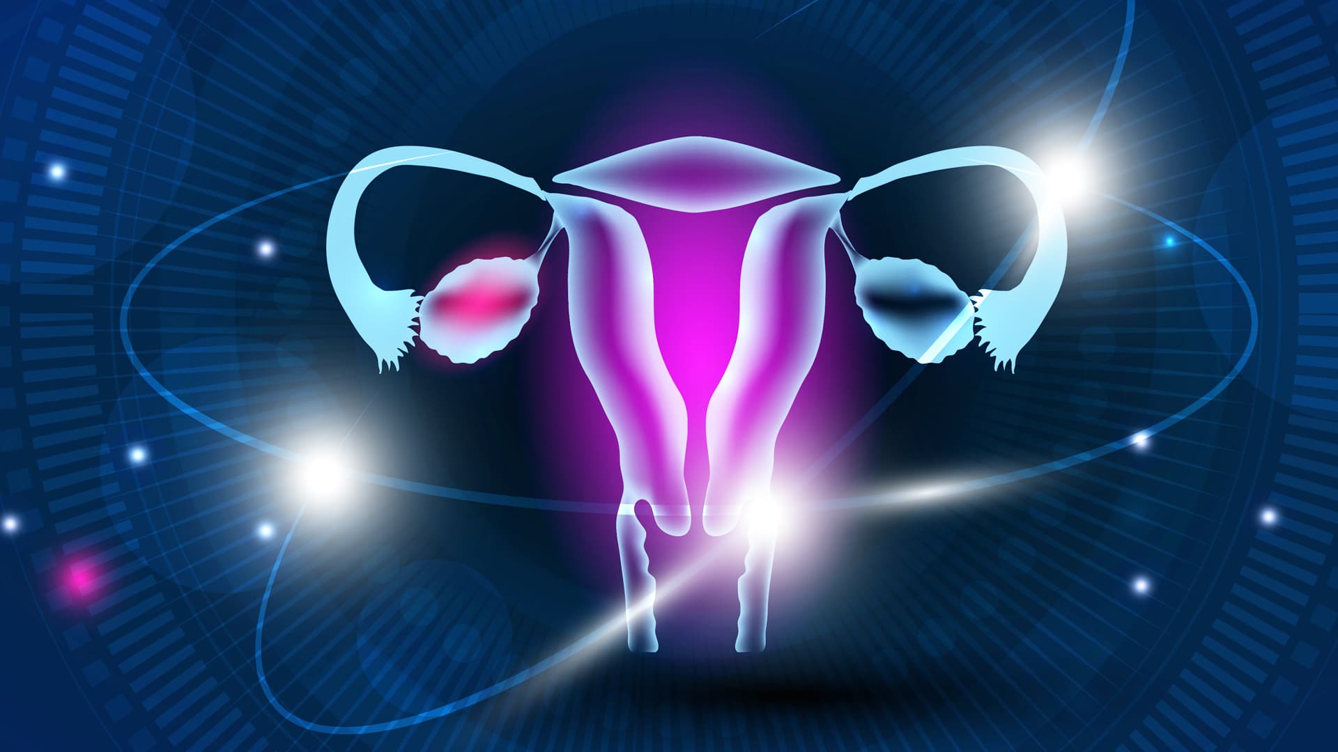 Myo Inositol en SOP para MG