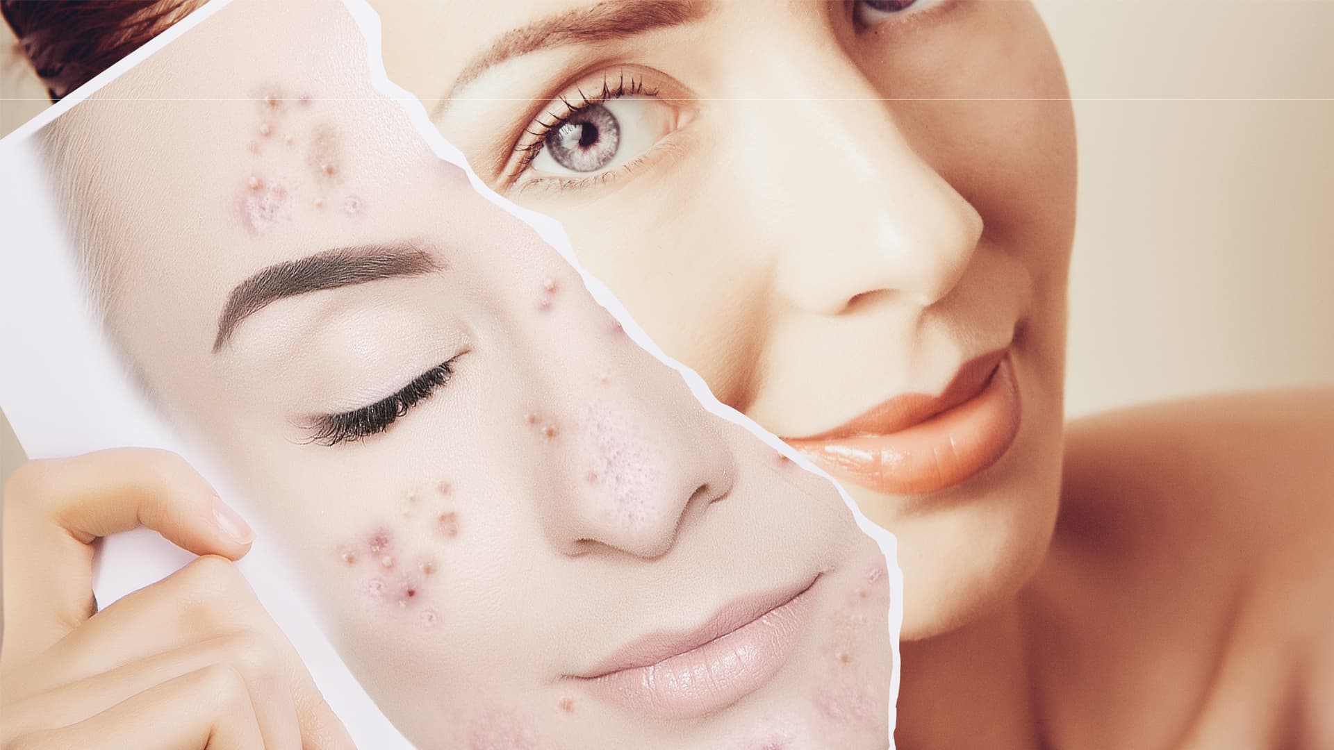 Abordaje del HiperAndrogenismo SOP